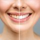 woman-teeth-before-after-whitening-white-background-dental-clinic-patient-image-symbolizes
