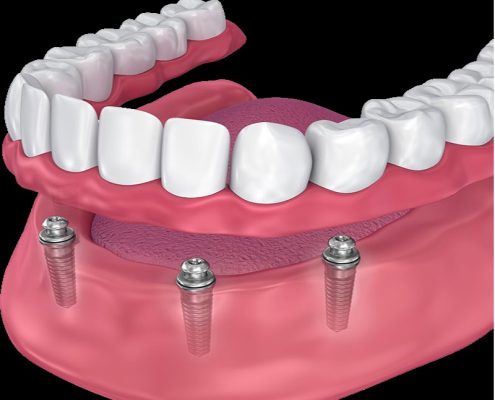 Dentures and Dental Implants Supported Dentures