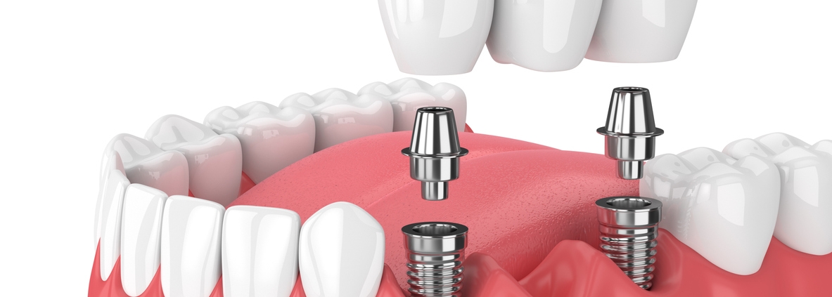 Dental Bridge