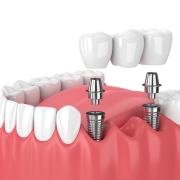 Dental Bridge