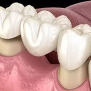Dental Bridges