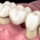 Dental Bridges