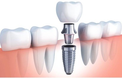 Dental Implants in North Little Rock AR