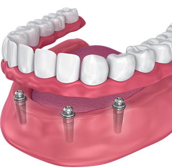 Dentures in North Little Rock AR